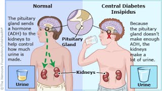 Central Diabetes Insipidus [upl. by Ztnaj]