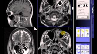 BRAIN MRI IN CASE SINUSITIS BILATERAL [upl. by Avalsorim]