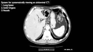 How to interpret an abdominal CT [upl. by Nelleoj]