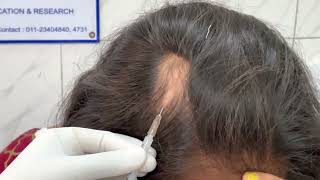 Alopecia areata  Injection technique for Triamcinolone acetonide  10 mgmL Dr Bhawuk Dhir [upl. by Terencio]