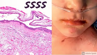 Staphylococcal scalded skin syndrome SSSS 5Minute Pathology Pearls [upl. by Ayana]