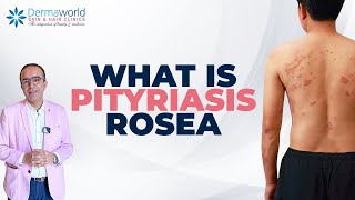 Skin Rash Pityriasis Rosea Hai  Symptoms Aur Treatment Explained  dermaworldskinclinics [upl. by Okihcas]