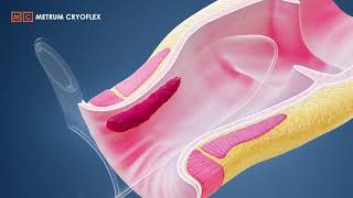 MILH procedure  Minimally Invasive Laser Hemorrhoidoplasty METRUM CRYOFLEX [upl. by Vick]