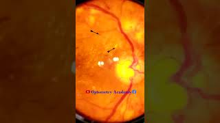 Diabetic retinopathy  Hemorrhages  cotton wool spots  Hard exudates  Fundus  Short Video 134 [upl. by Winer]