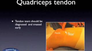 Quadriceps Tendon Tear [upl. by Lora]