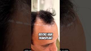 Hair transplant postop 4000 grafts for hairline and crown restoration vincihairclinic shorts [upl. by Nabalas]