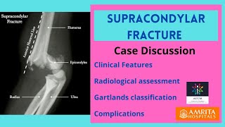 Supracondylar Fracture  Case Discussion [upl. by Nnave745]