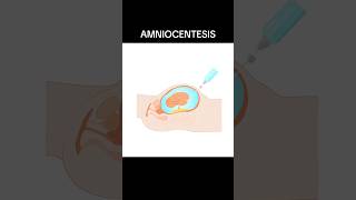 AMNIOCENTESIS amniocentesis  WHAT IS AMNIOCENTESIS shortsviraltrending [upl. by Anneliese594]