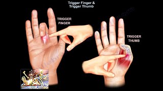 Trigger Finger amp Trigger Thumb  Everything You Need To Know  Dr Nabil Ebraheim [upl. by Arbas599]