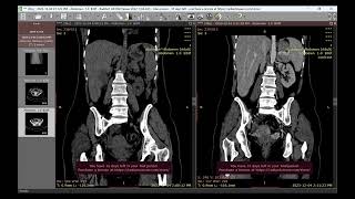 Liver abscess pyogenic [upl. by Thatch]