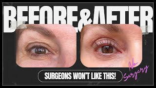 SKIP the surgery This eyelid treatment WORKS TIXEL eyelid LIFT [upl. by Rise]