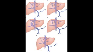 Portosystemic Shunt Surgical procedure  Definition Indications Procedure Types Advantages [upl. by Zelikow613]