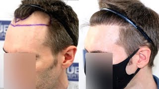 FUE Hair Transplant 1500 Grafts NW III A By Dr Juan Couto  FUEXPERT CLINIC Madrid Spain [upl. by Aerdnak836]