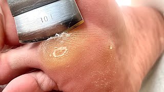 Callus removal from feetampFoot scraping dead skin【Xiao Yan pedicure】stress 36 [upl. by Hilarius]