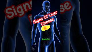 Liver Disease Warning Signs  Liver Disease Symptoms  Liver Damage  Acute Liver Failure [upl. by Frazer]