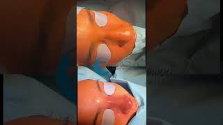 Rhinoplastie ultrasonique preservationrhinoplasty rhinoexpert [upl. by Balkin167]