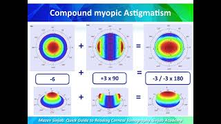 A Quick Guide to Reading Corneal Tomography Part 3 [upl. by Eberle]