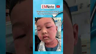 Staphylococcal Scalded Skin Syndrome SSSS [upl. by Mcgee]