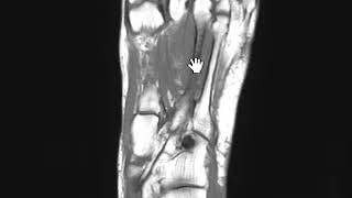 Metatarsal stress fracture by MRI [upl. by Jacinta]