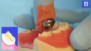 Stainless Steel Crown Technique for a Primary Molar Tooth [upl. by Mattias]