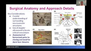 Pituitary Adenomas Diagnosis and Management by Sheena Kalagara [upl. by Annaed]