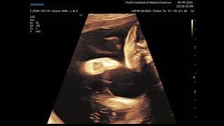 Arthrogryposis Multiplex congenita fetal ultrasound [upl. by Mcginnis233]