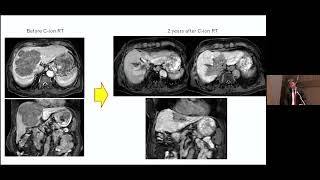 Day3 Room3 HCC 7 Advancements in Radiation Therapy for Hepatocellular Carcinoma [upl. by Liss527]