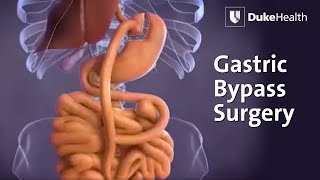 Gastric Bypass Surgery  Duke Health [upl. by Dickey57]