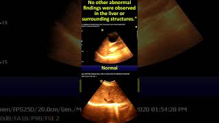 Ultrasonography of Liver Cyst Sonographic Report amp Interpretation [upl. by Ebony]