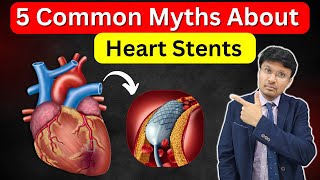 Heart Stents Debunking 5 Myths MUST WATCH for Heart Health [upl. by Elbam]