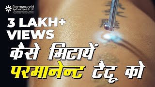 How To remove Tattoo Permanently  कैसे मिटायें परमानेंट टैटू को [upl. by Brande]