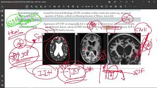 50 Idiopathic Intracranial Hypertension Pseudotumor Cerebri [upl. by Jac474]