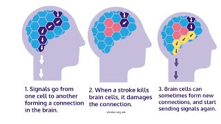 Positive Aspects Of Stroke Recovery [upl. by Farro]