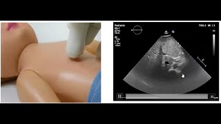 Basics of Pediatric Echocardiography Determining the Situs by Dr Gaurav Agrawal [upl. by Themis]