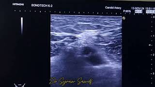 adductor canal block for post op analgesia at knee joint [upl. by Ytsim707]