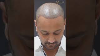 Artas Robotic Hair Restoration in Ahmedabad at Musk Clinic [upl. by Natfa]