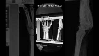 Xray left wrist Aplat [upl. by Lois]