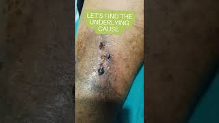 Non healing Wounds treatment with leech therapy unanidoctor unani skincare [upl. by Bedelia]