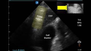 Appearance of Pneumoperitoneum on Right Upper Quadrant Ultrasound [upl. by Aihsa]