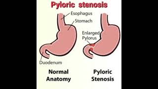 Pyloric stenosis Fluid calculation mrcpch Recall Communication [upl. by Samanthia]