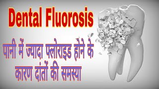 Dental Fluorosis  पानी में ज्यादा फ्लोराइड होने के कारण दांतों की परेशानी  treatment of fluorosis [upl. by Avilla589]