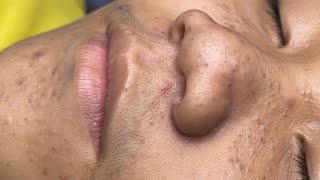 ACNE TREATMENT VU QUYNH MI  Blackheads Chin amp Nose Of Tweens 2024 EX [upl. by Yerffoeg]