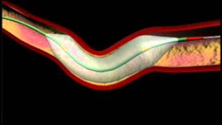 Balloon Angioplasty and Stenting Animation [upl. by Timms]