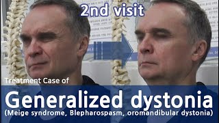 Generalized dystonia  Meige syndrome  Blepharospasm oromandibular dystonia  전신사경증 치료사례 [upl. by Aivilo]