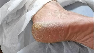 Fissure on heel and Remove it slowly amp carefully from heel Cracked heel treatment amp Callus removal [upl. by Luap]