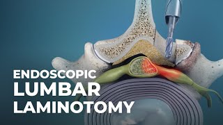 Endoscopic Lumbar Laminotomy AtlanticSpineCenter [upl. by Eiramanad600]