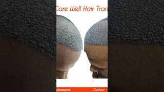 haircare hairlossttreatment besthairtransplantresults hairtransplantclinic hairtransplant [upl. by Nylazor122]