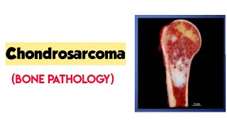 ChondrosarcomaBone pathologyRobbins pathologybone tumorforward focused [upl. by Nonnaer]