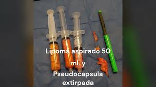 Lipoma liposucción 36 [upl. by Ledda]