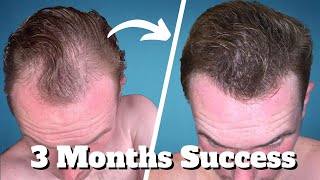 TOPICAL FINASTERIDE The GREATEST Underrated Hair Remedy [upl. by Levona]